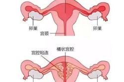 重塑生命之门间充质干细胞治疗宫腔粘连与生育希望的复兴