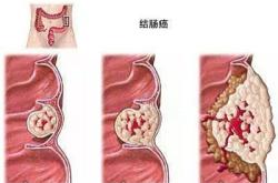 结肠癌术后用中医能预防复发吗？效果会好吗